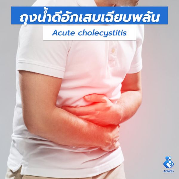 ถุงน้ำดีอักเสบเฉียบพลัน (Acute
cholecystitis)