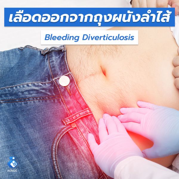 เลือดออกจากถุงผนังลำไส้
(Bleeding Diverticulosis)