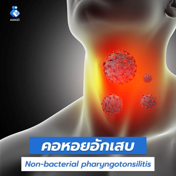 คอหอยอักเสบ
(Non-bacterial pharyngotonsillitis)