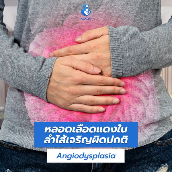 หลอดเลือดในลำไส้เจริญผิดปกติ
(Angiodysplasia)