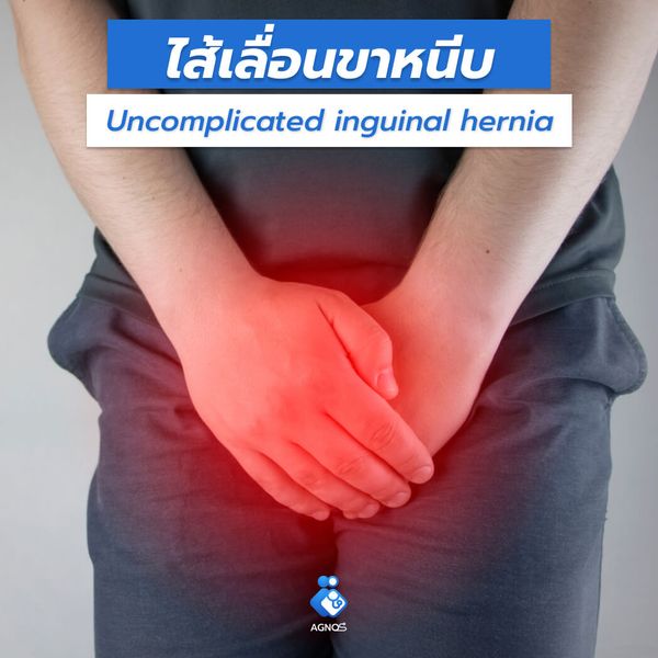 ไส้เลื่อนขาหนีบ
(Uncomplicated inguinal hernia)