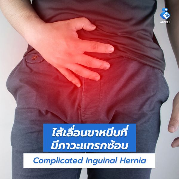 ไส้เลื่อนขาหนีบที่มีภาวะแทรกซ้อน
(Complicated Inguinal Hernia)