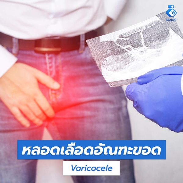 หลอดเลือดอัณฑะขอด (Varicocele)