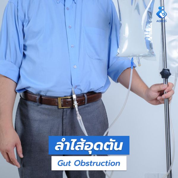 ลำไส้อุดตัน (Gut Obstruction)