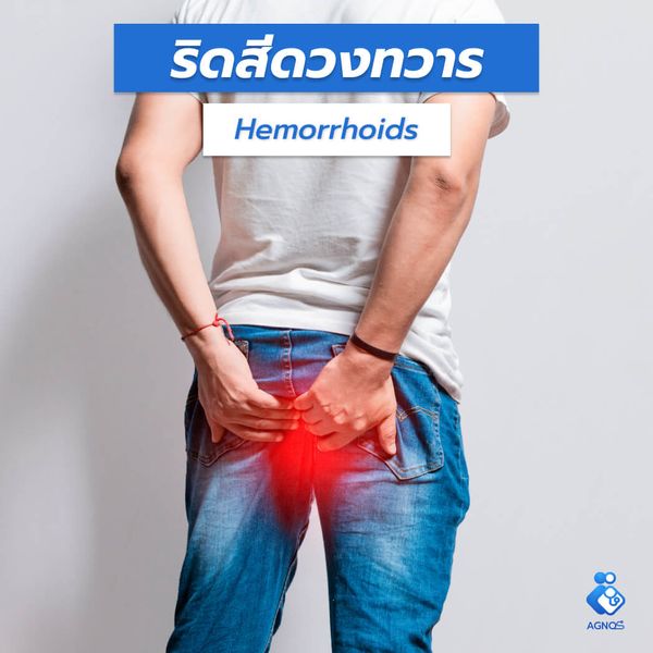 ริดสีดวงทวาร (Hemorrhoids)