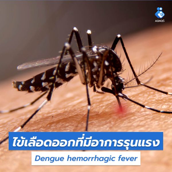 ไข้เลือดออกที่มีอาการรุนแรง
(Dengue hemorrhagic fever)