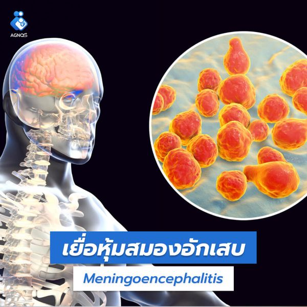 เยื่อหุ้มสมองอักเสบ (Meningitis)