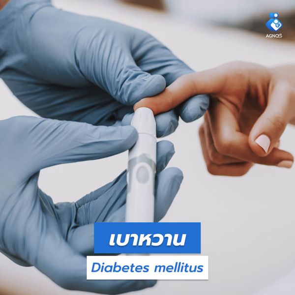 เบาหวาน (Diabetes mellitus)