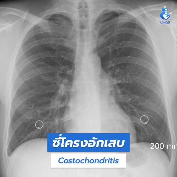 ซี่โครงอักเสบ (Costochondritis)