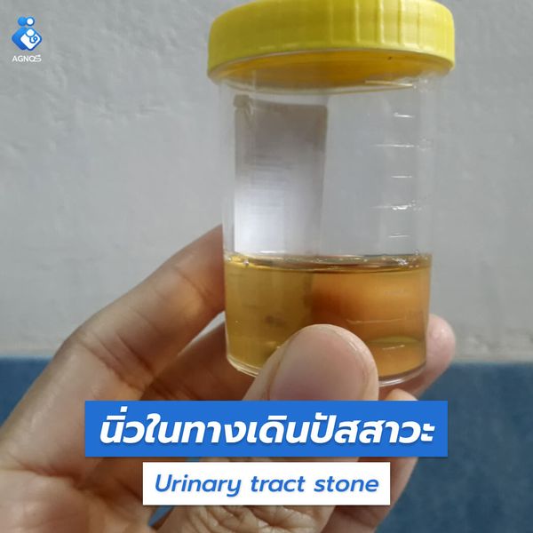 นิ่วในทางเดินปัสสาวะ (Urinary
tract stone)