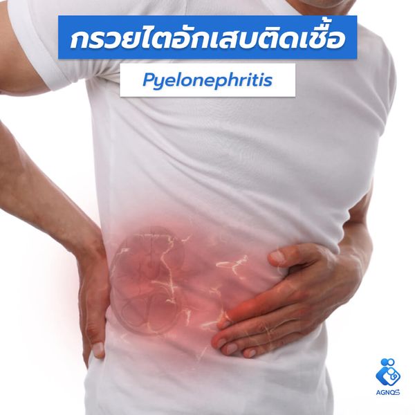กรวยไตอักเสบติดเชื้อ
(Pyelonephritis)