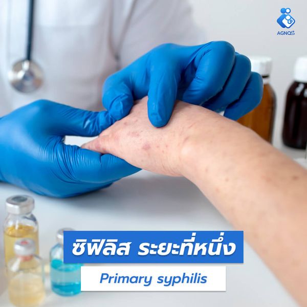 ซิฟิลิส ระยะที่หนึ่ง (Primary
syphilis)