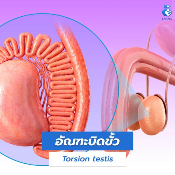 อัณฑะบิดขั้ว (Torsion testis)