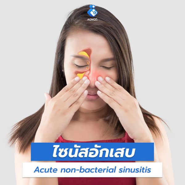 ไซนัสอักเสบ (Acute
non-bacterial sinusitis)