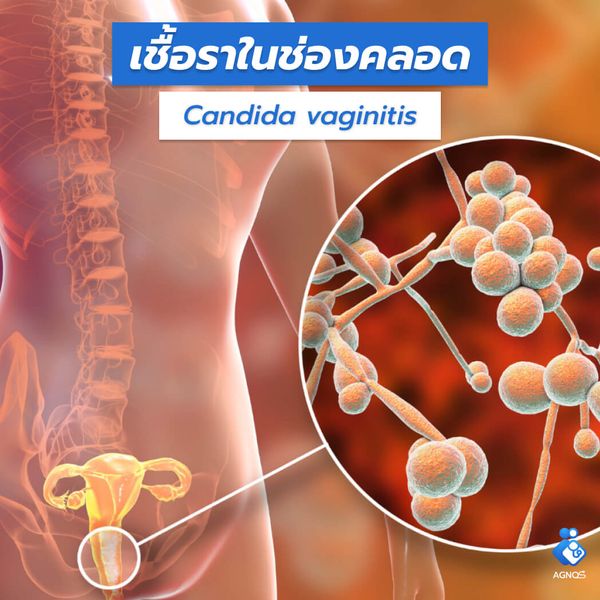 เชื้อราในช่องคลอด (Candida vaginitis)