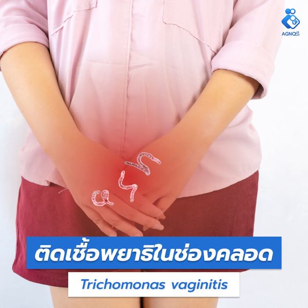 ติดเชื้อพยาธิในช่องคลอด
(Trichomonas vaginitis)