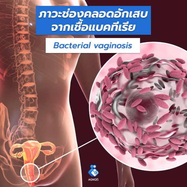 ภาวะช่องคลอดอักเสบจากเชื้อแบคทีเรีย
(Bacterial vaginosis)