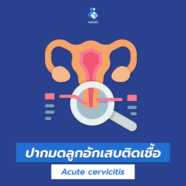 ปากมดลูกอักเสบติดเชื้อ (Acute
cervicitis)