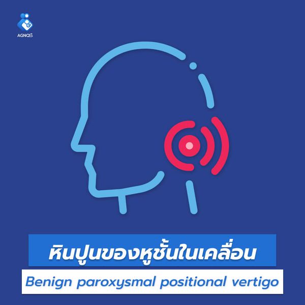 หินปูนของหูชั้นในเคลื่อน
(Benign paroxysmal positional vertigo)