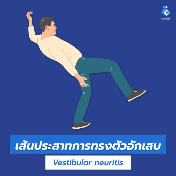 เส้นประสาทการทรงตัวอักเสบ
(Vestibular neuritis)