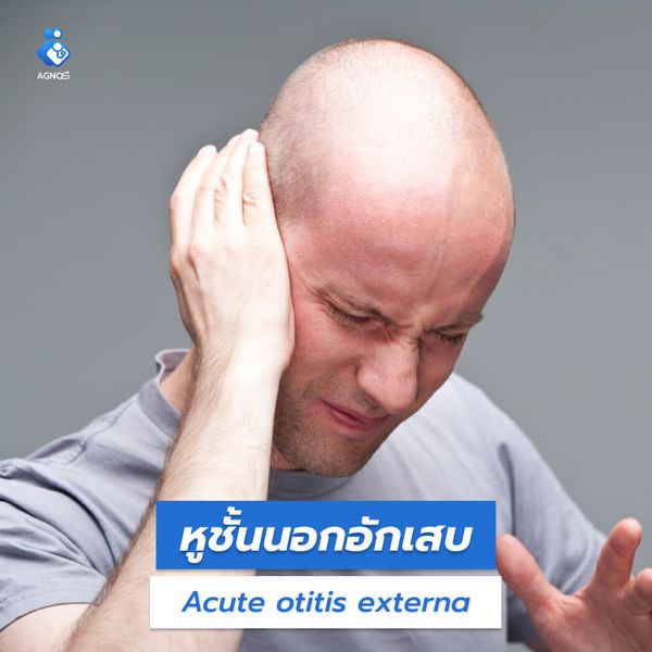 หูชั้นนอกอักเสบ (Acute otitis
externa)