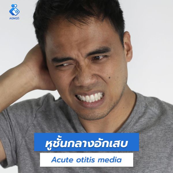 หูชั้นกลางอักเสบ (Acute otitis
media)