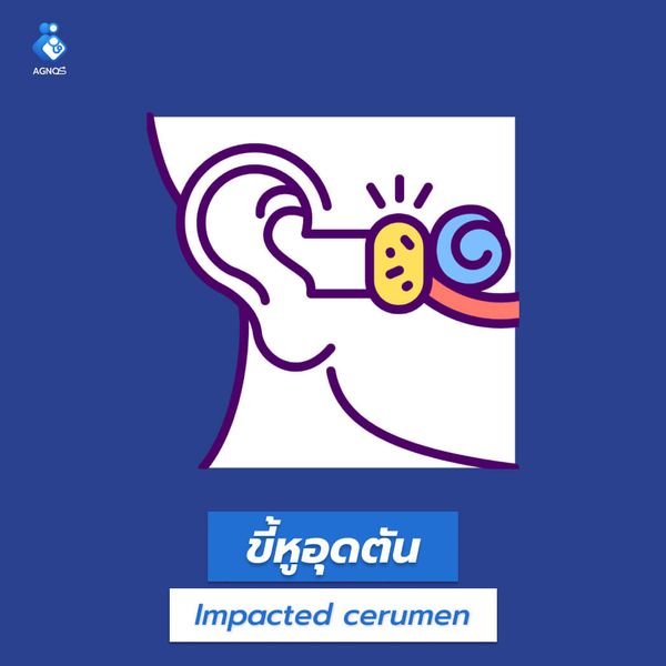ขี้หูอุดตัน (Impacted cerumen)