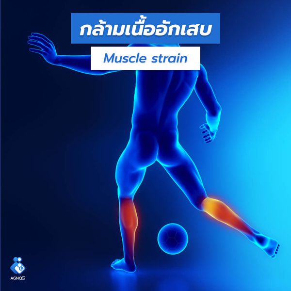 กล้ามเนื้ออักเสบ (Muscle strain)