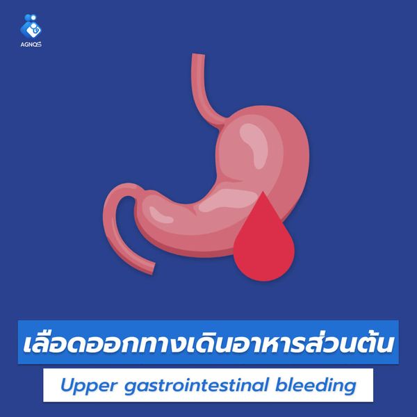 เลือดออกทางเดินอาหารส่วนต้น
(UGIB unspecified)