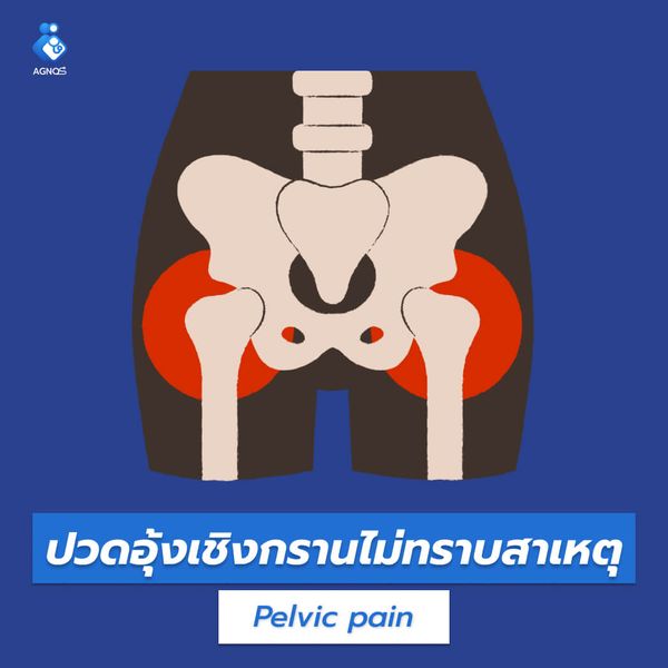 ปวดอุ้งเชิงกรานไม่ทราบสาเหตุ
(Pelvic pain unspecified)