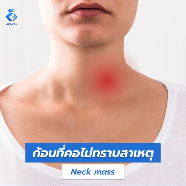 ก้อนที่คอไม่ทราบสาเหตุ (Neck
mass unspecified)