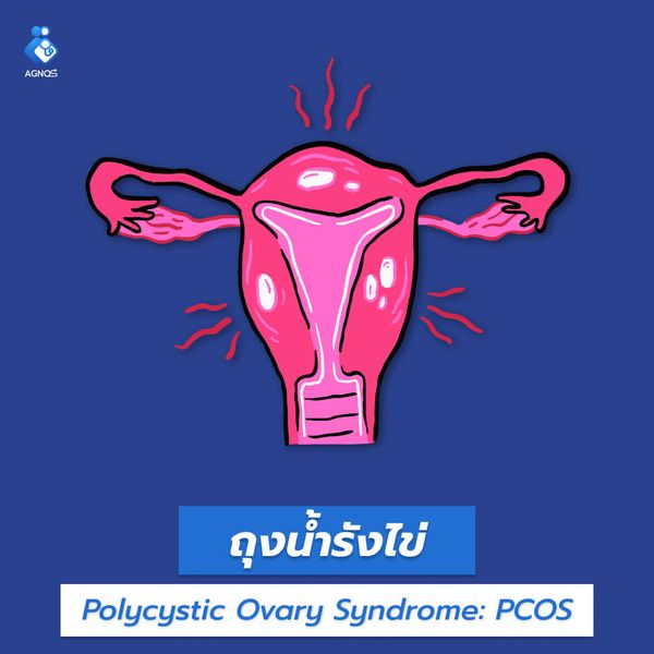 ถุงน้ำรังไข่ (PCOS)