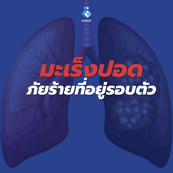 มะเร็งปอด ภัยร้ายที่อยู่รอบตัว
