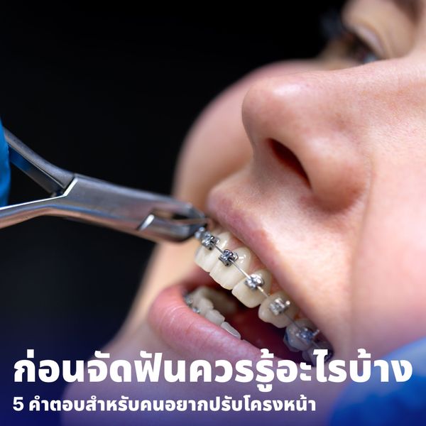 ก่อนจัดฟันควรรู้อะไรบ้าง? 5 คำตอบสำหรับคนอยากจัดฟันเพื่อปรับโครงหน้า